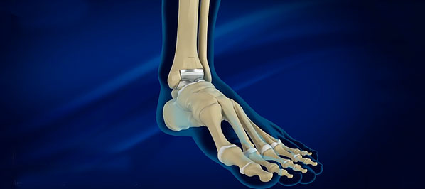 artroplastia-tornozelo