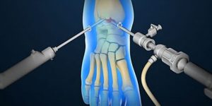 artroscopia-pe-tornozelo