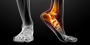 artrose-pe-tornozelo