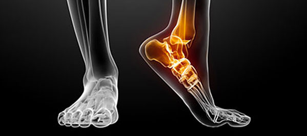 artrose-pe-tornozelo